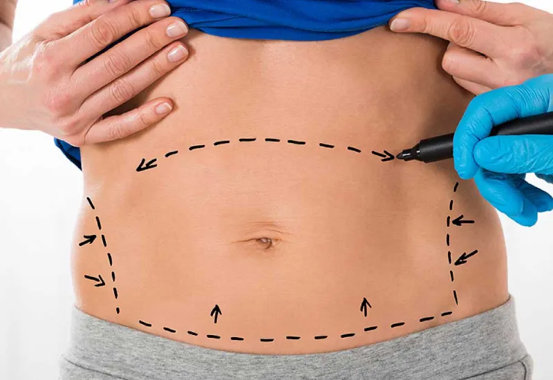 Abdominoplasty Recovery