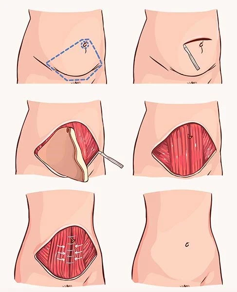 Abdominoplasty in Iran