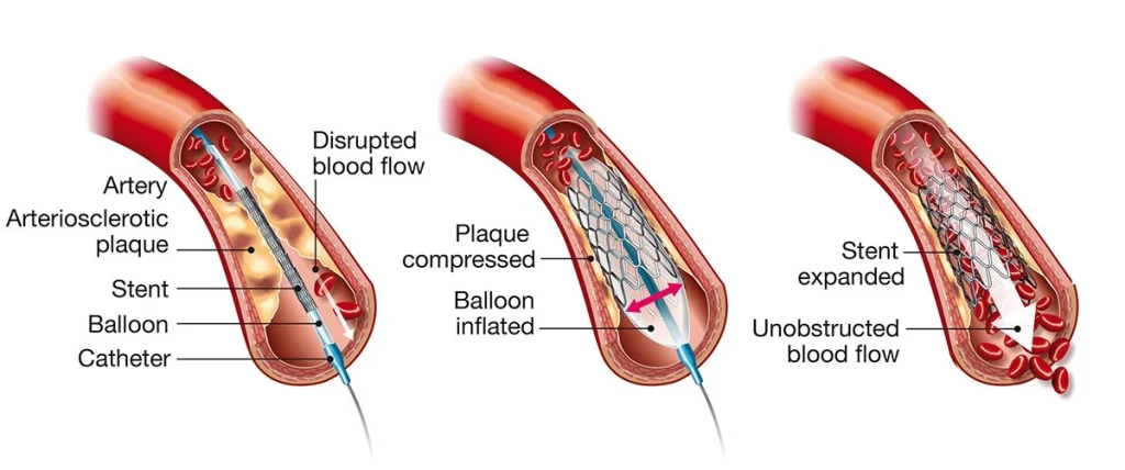 Angioplasty in Iran