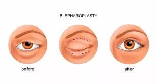 Blepharoplasty Before After