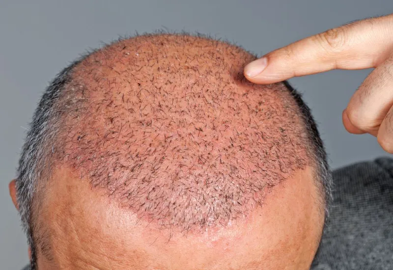 الآثار الجانبية لزراعة الشعر