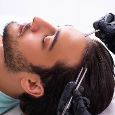 Hair Transplant in Iran