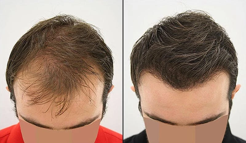 Hair Transplantation in Iran Before After