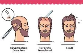 Hair Transplantation in Iran