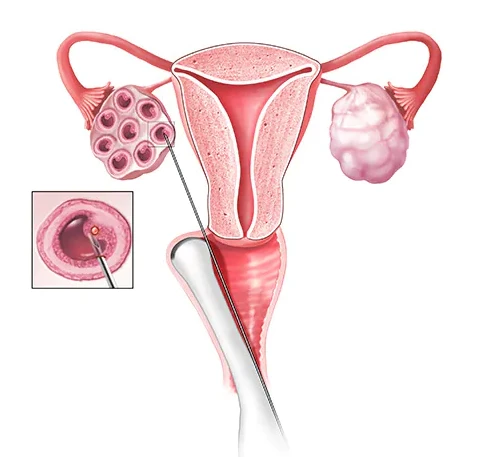 In Vitro Fertilization in Iran