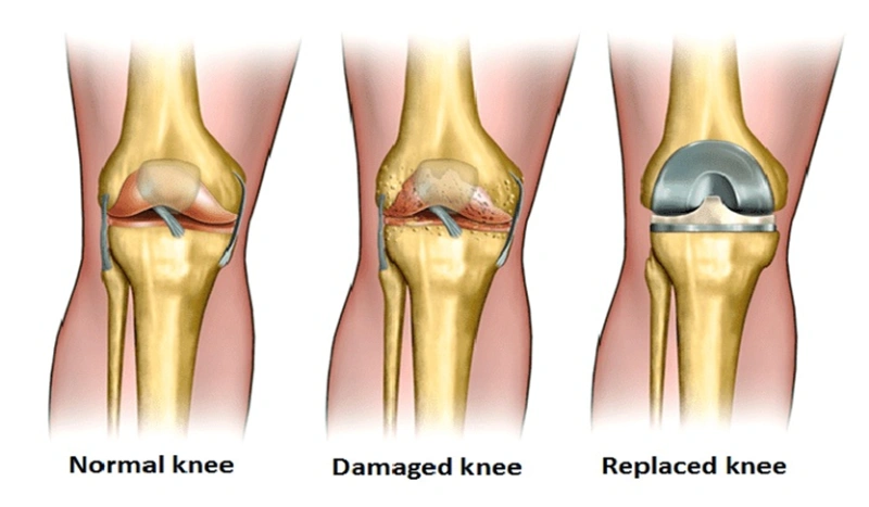 Knee Replacement Surgery in Iran