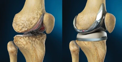 Knee Replacement Surgery in Iran