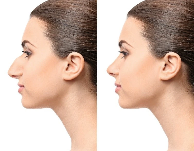 Rhinoplasty Before After