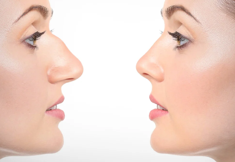 Rhinoplasty before and after