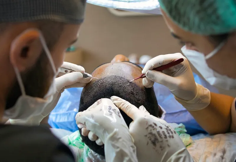 Hair Transplant