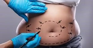 tummy tuck in Iran