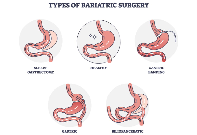 Weight Loss Surgery Options