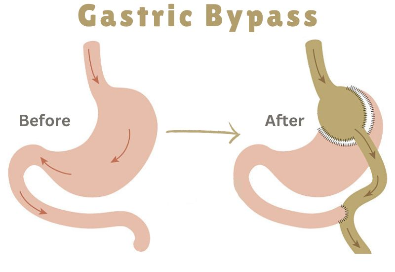 Gastric Bypass 