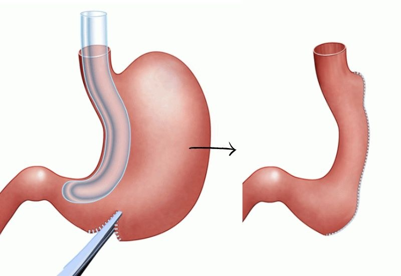 Gastric Sleeve Surgery Success Rate