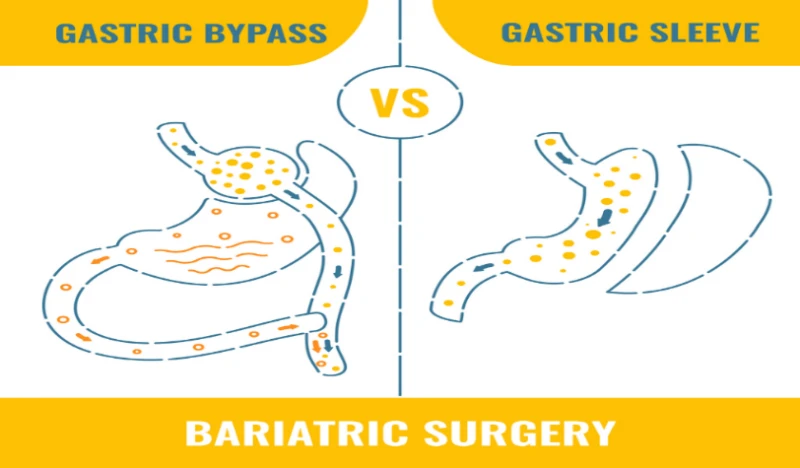 Gastric Sleeve vs Gastric Bypass