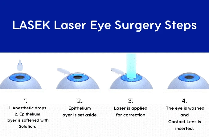 Lasek Laser Eye Surgery Steps