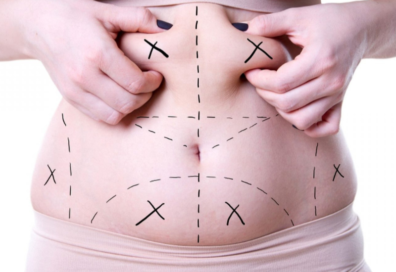 liposuction