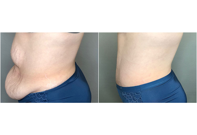 Panniculectomy before and after