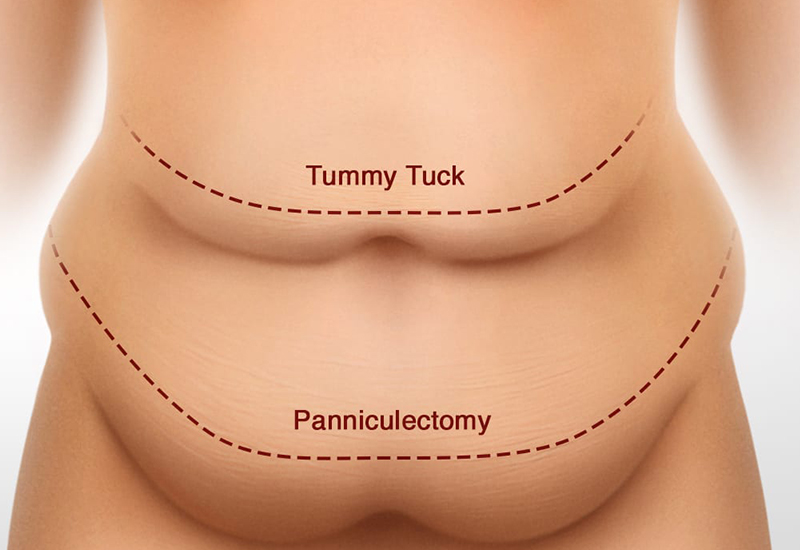 Panniculectomy vs Tummy Tuck