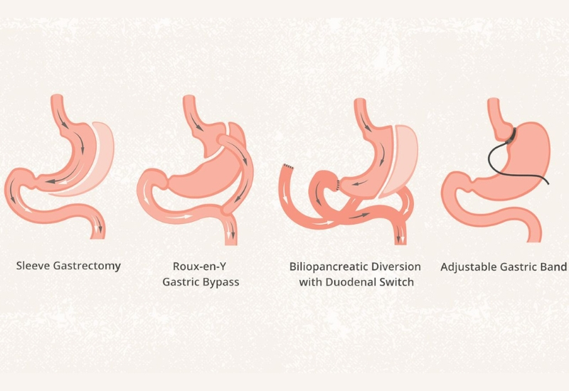 Weight Loss Surgery Types