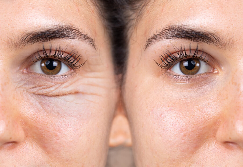 blepharoplasty