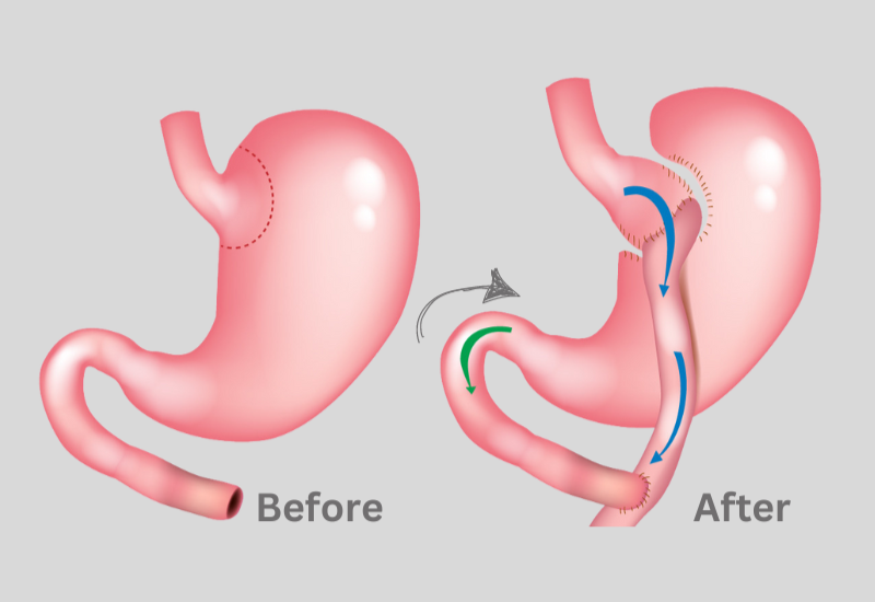 Gastric Bypass Surgery risks