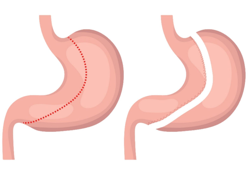 gastric sleeve surgery cost