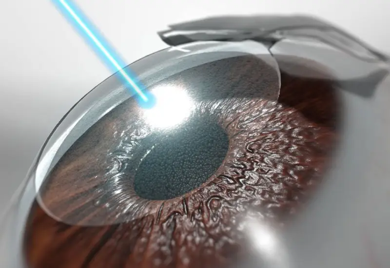 What is LASIK eye surgery? (Types, Cost, Recovery Time)