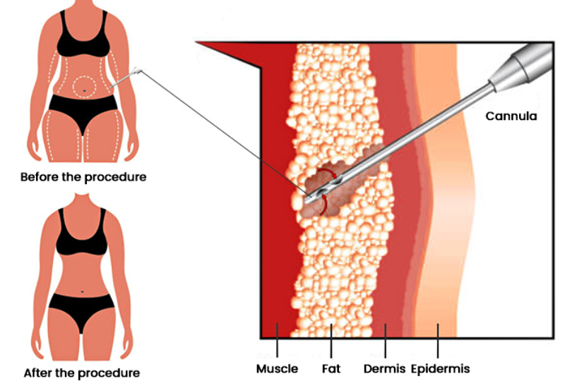 liposuction cost