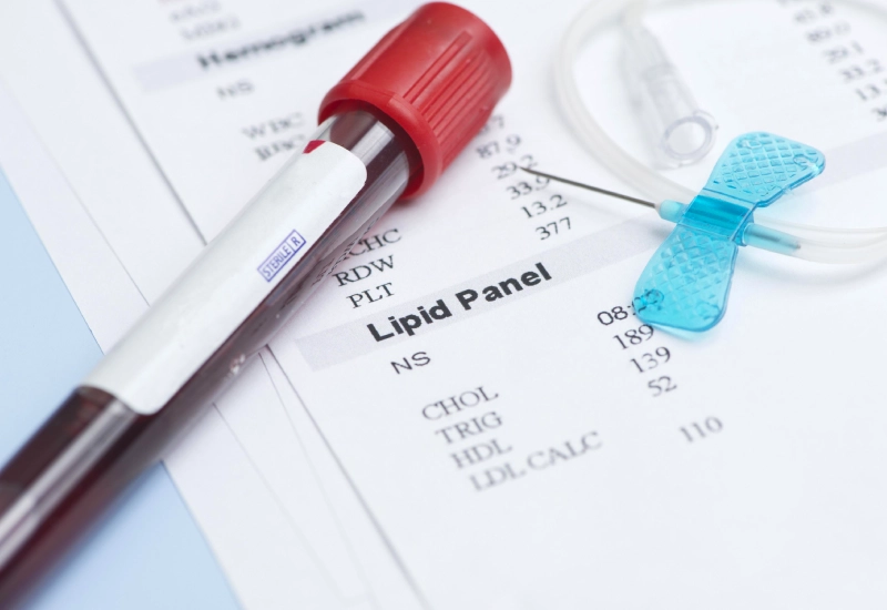 Hyperlipidemia Blood Test