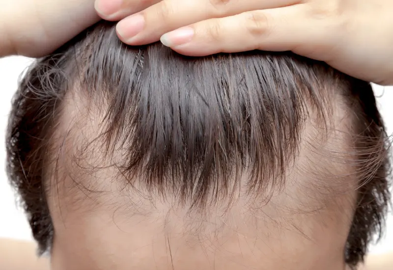 Traction alopecia signs