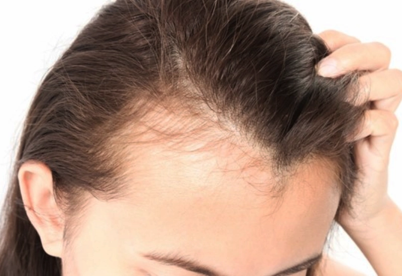 Traction alopecia women