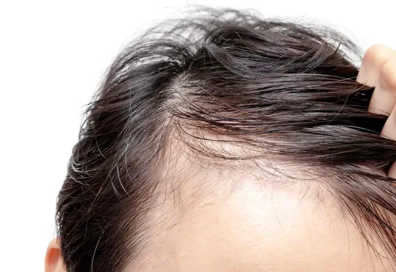 androgenetic alopecia