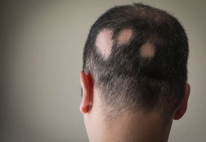 Androgenetic Alopecia Causes