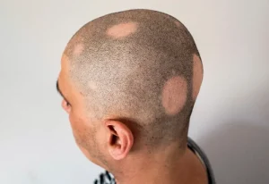 Androgenetic Alopecia