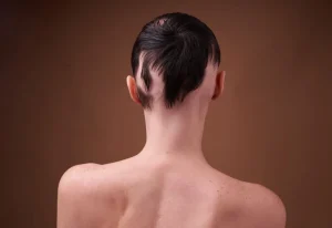 what is alopecia areata?