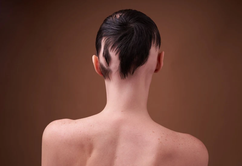 What is Alopecia Areata? (Symptoms, Causes, Treatment)