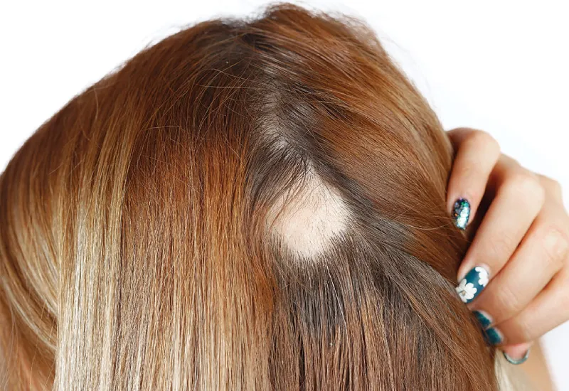 alopecia areata symptoms