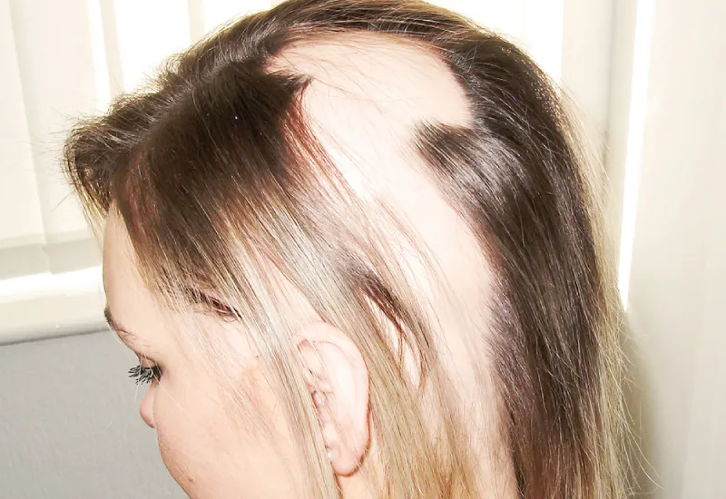 alopecia areata cuases