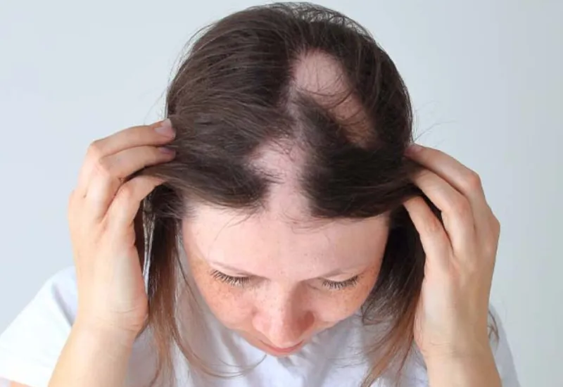 living aith alopecia