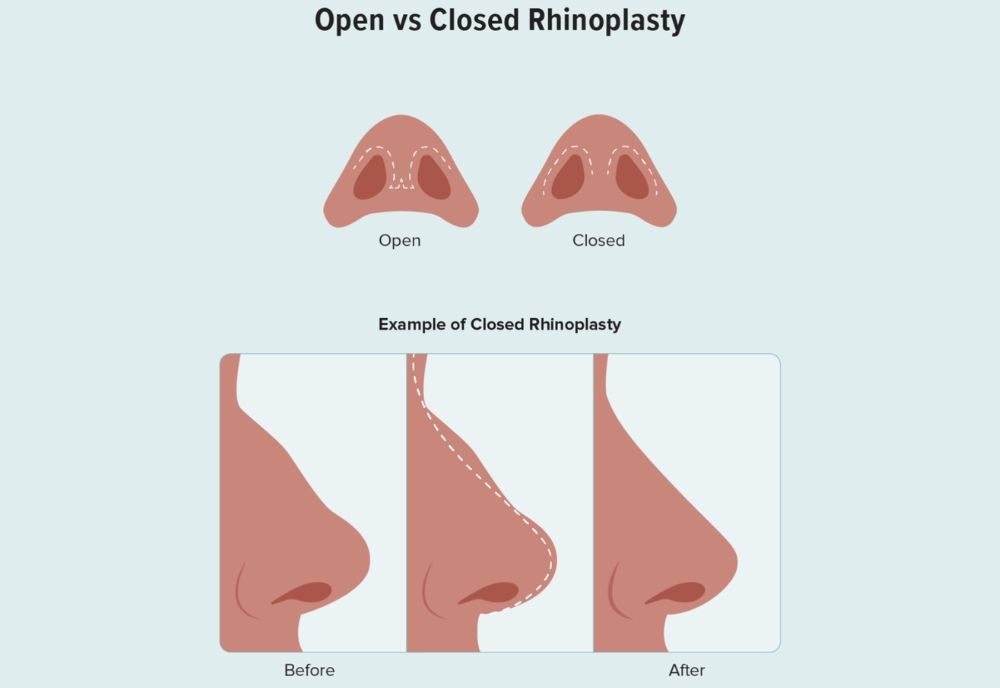 open vs closed rhinoplsty