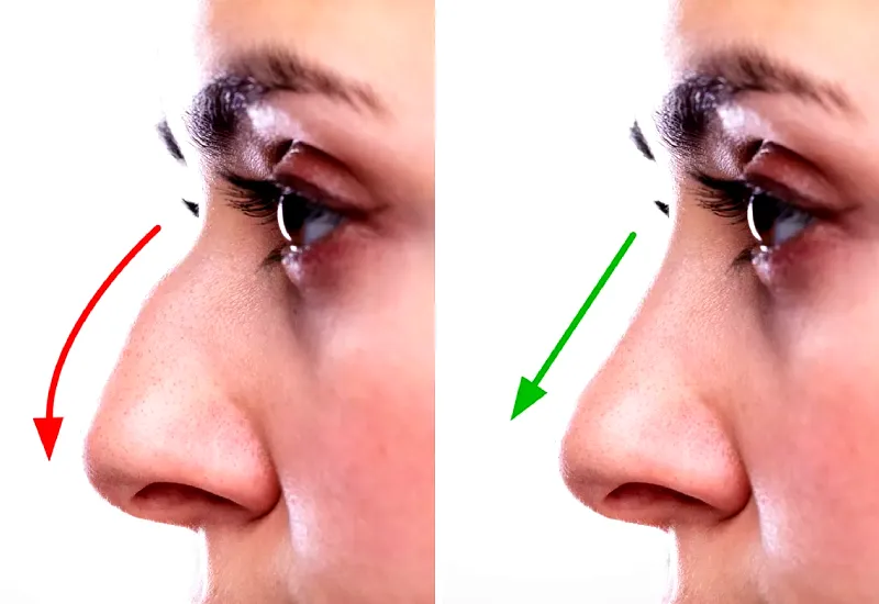 post care after rhinoplasty