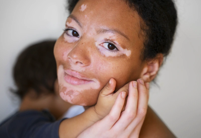 Vitiligo Skin