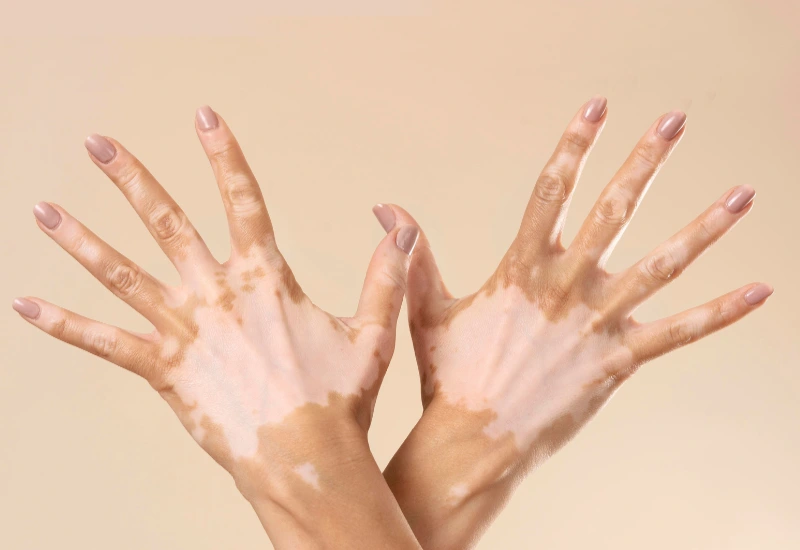 Vitiligo Treatment