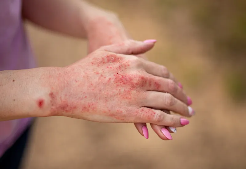 eczema triggers