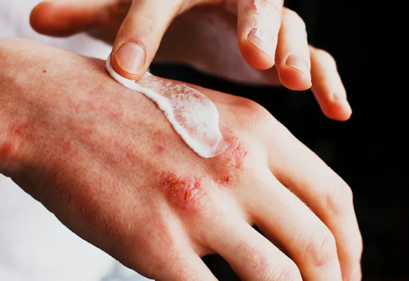 eczema treatment