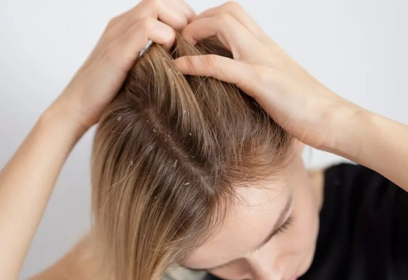 itchy scalp treatments