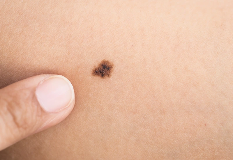 mole on skin