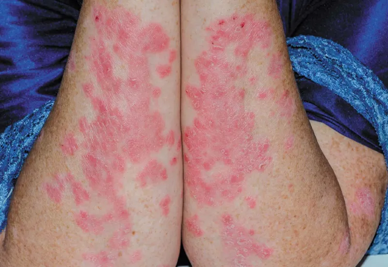 what is psoriasis?