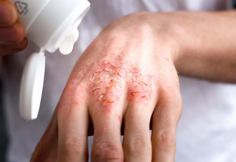 psoriasis skin care